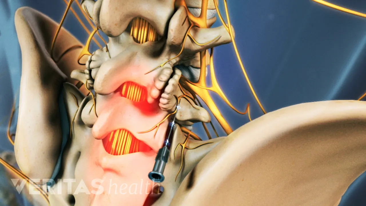 Lumbar Rfa Radiofrequency Ablation (RFA)
