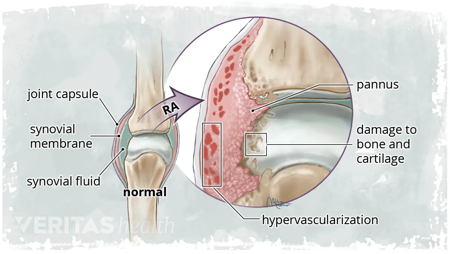 What Is Pannus?