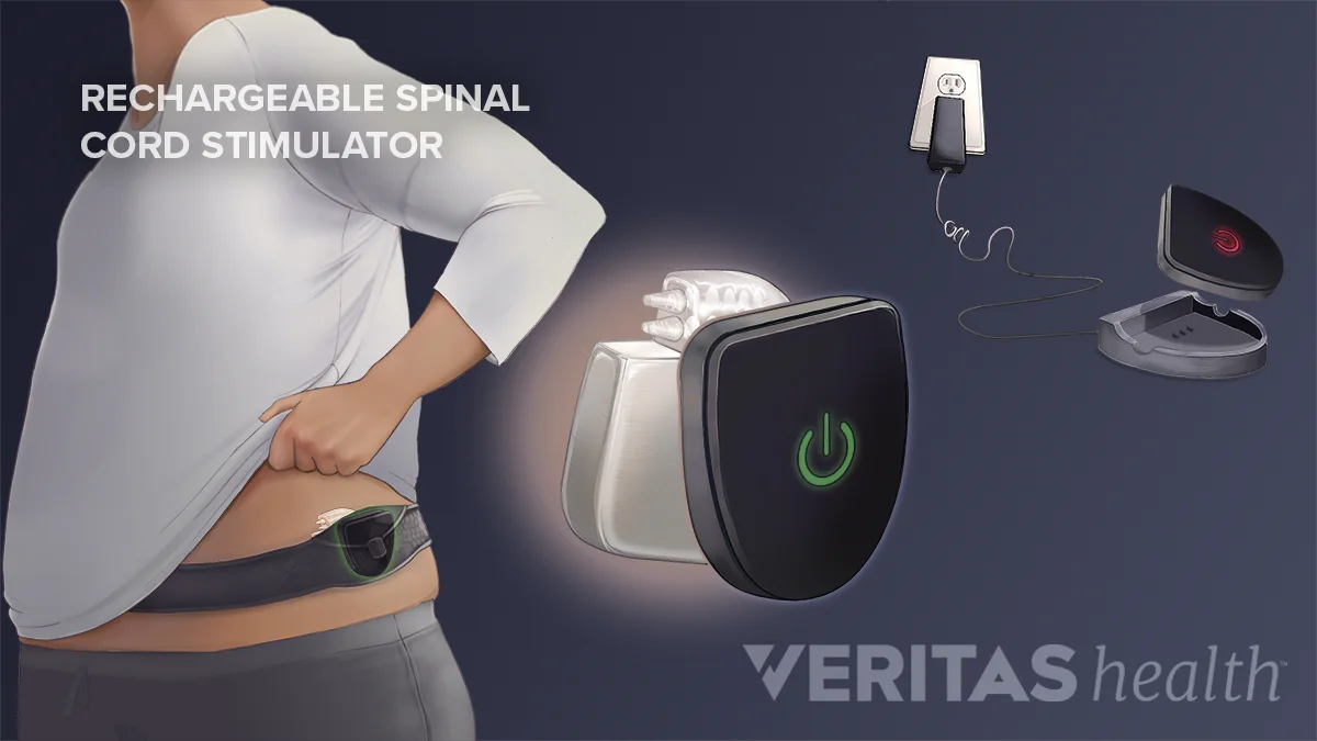 Recovery After Spinal Cord Stimulation Trial