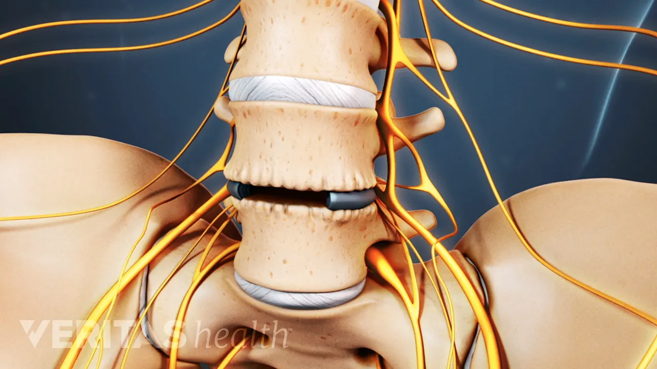 Lower Back Surgery Risks Surgery for Lower Back Pain