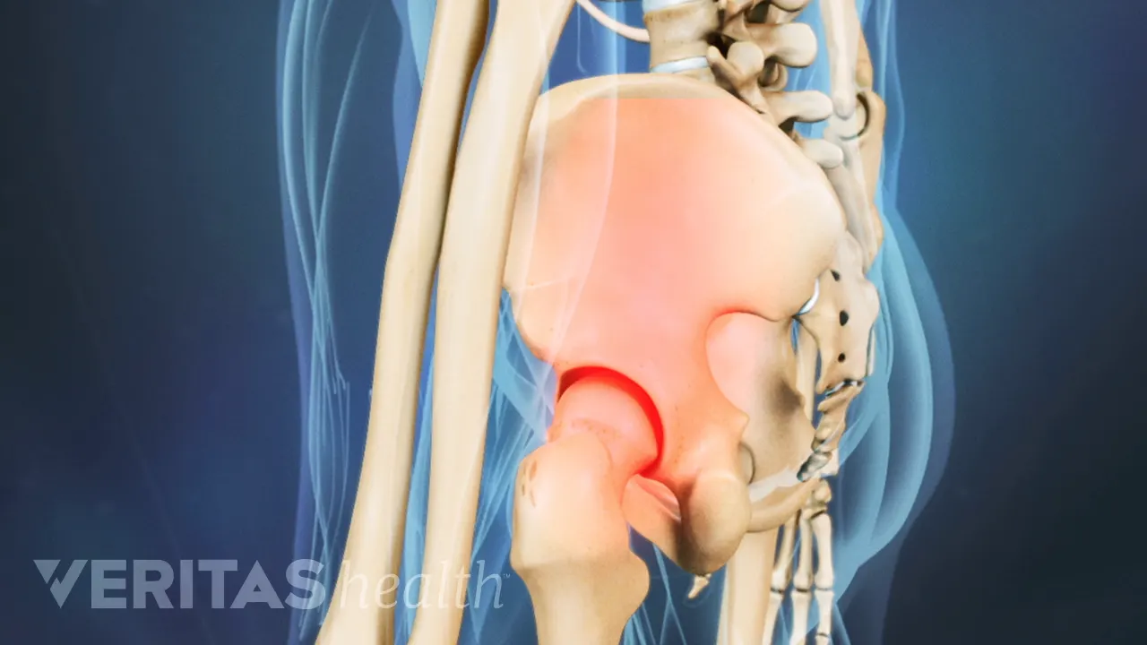 Sacroiliac Joint Dysfunction Video