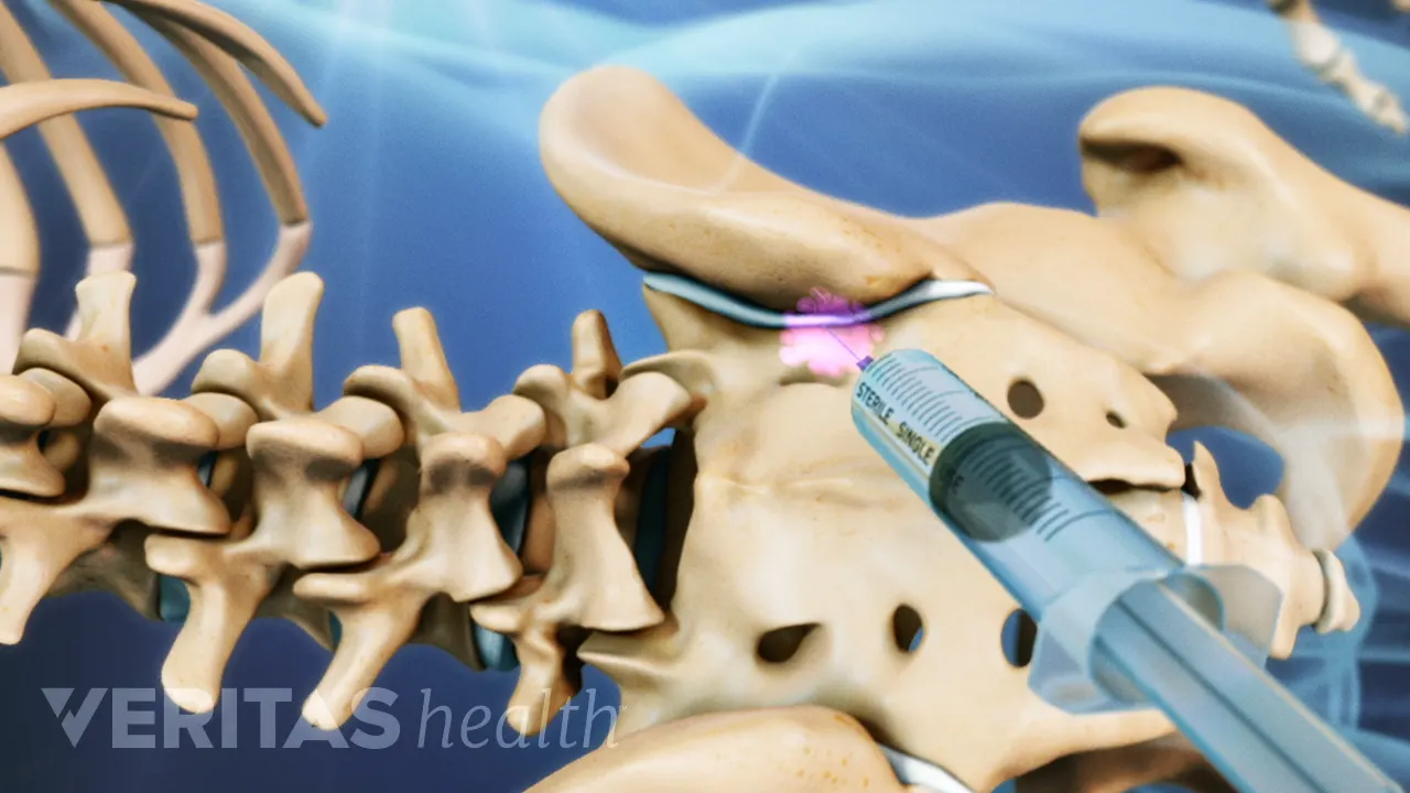 Sacroiliac (SI) Joint Injections