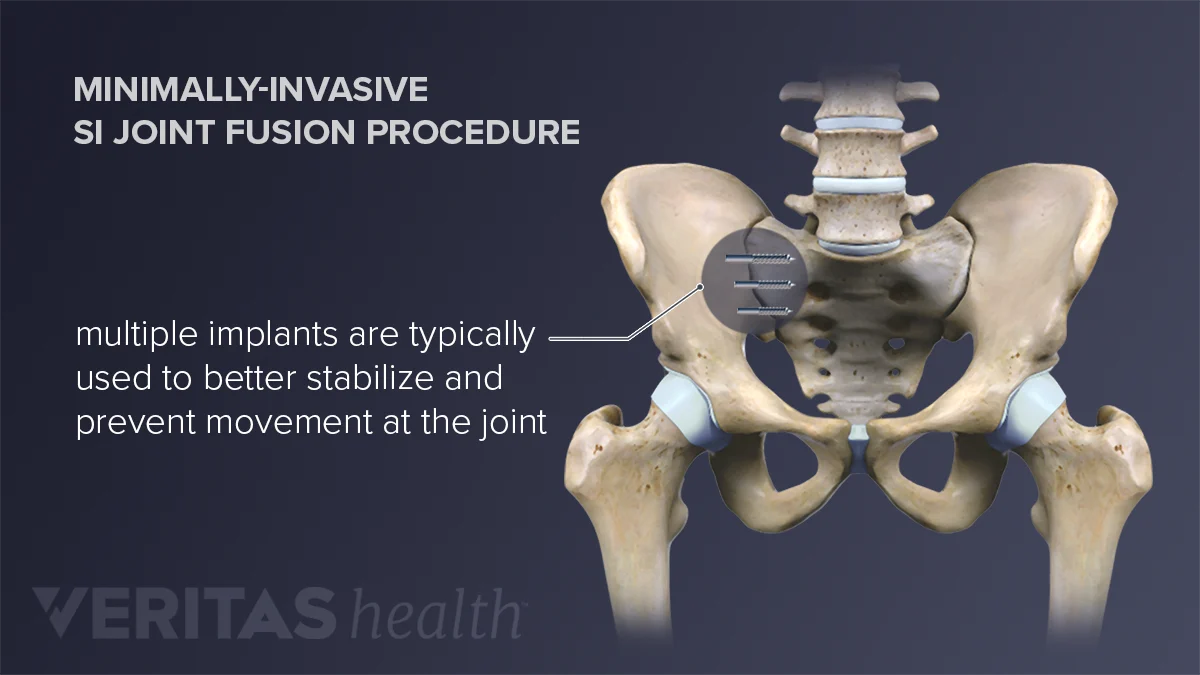 How Sacroiliac Joint Fusion is Performed