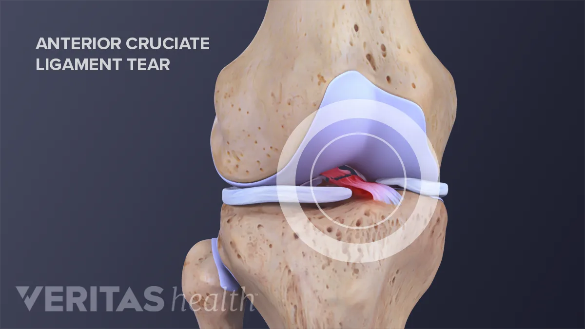 Acl External Rotation Tore Acl Anatomy Torn ACL 🏃♀ A Torn ACL (anterior Cruciate
