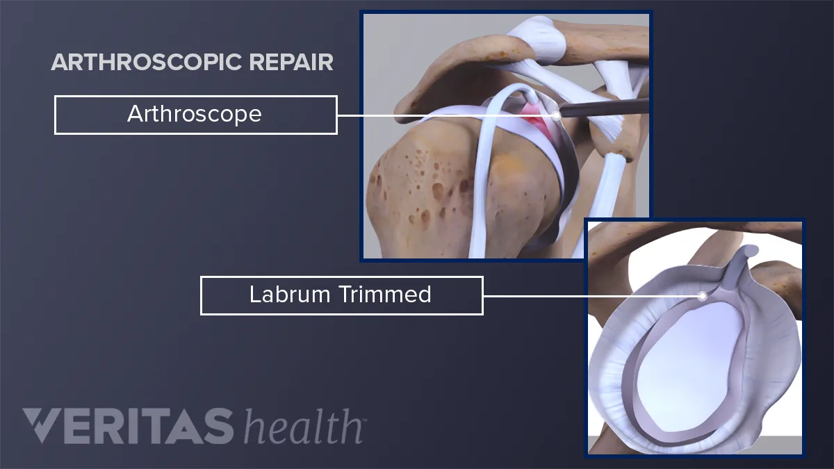 Labrum Tear Treatments