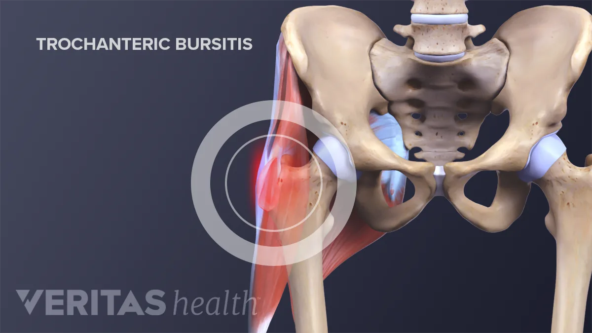 Hip Trochanteric Bursitis Hip Trochanteric Bursitis