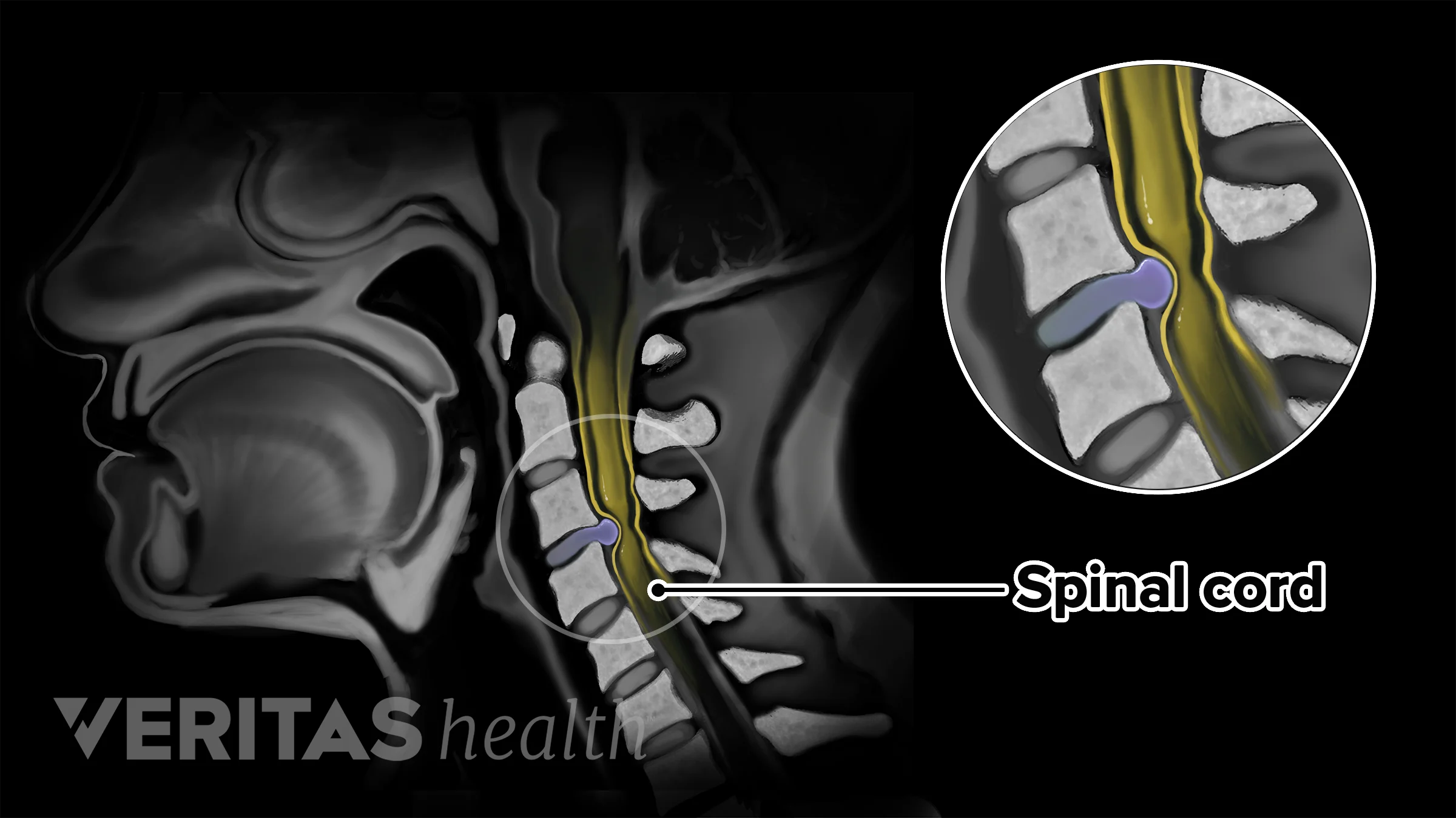 Multi Level Extension Spondylosis X Ray Cervical Spine