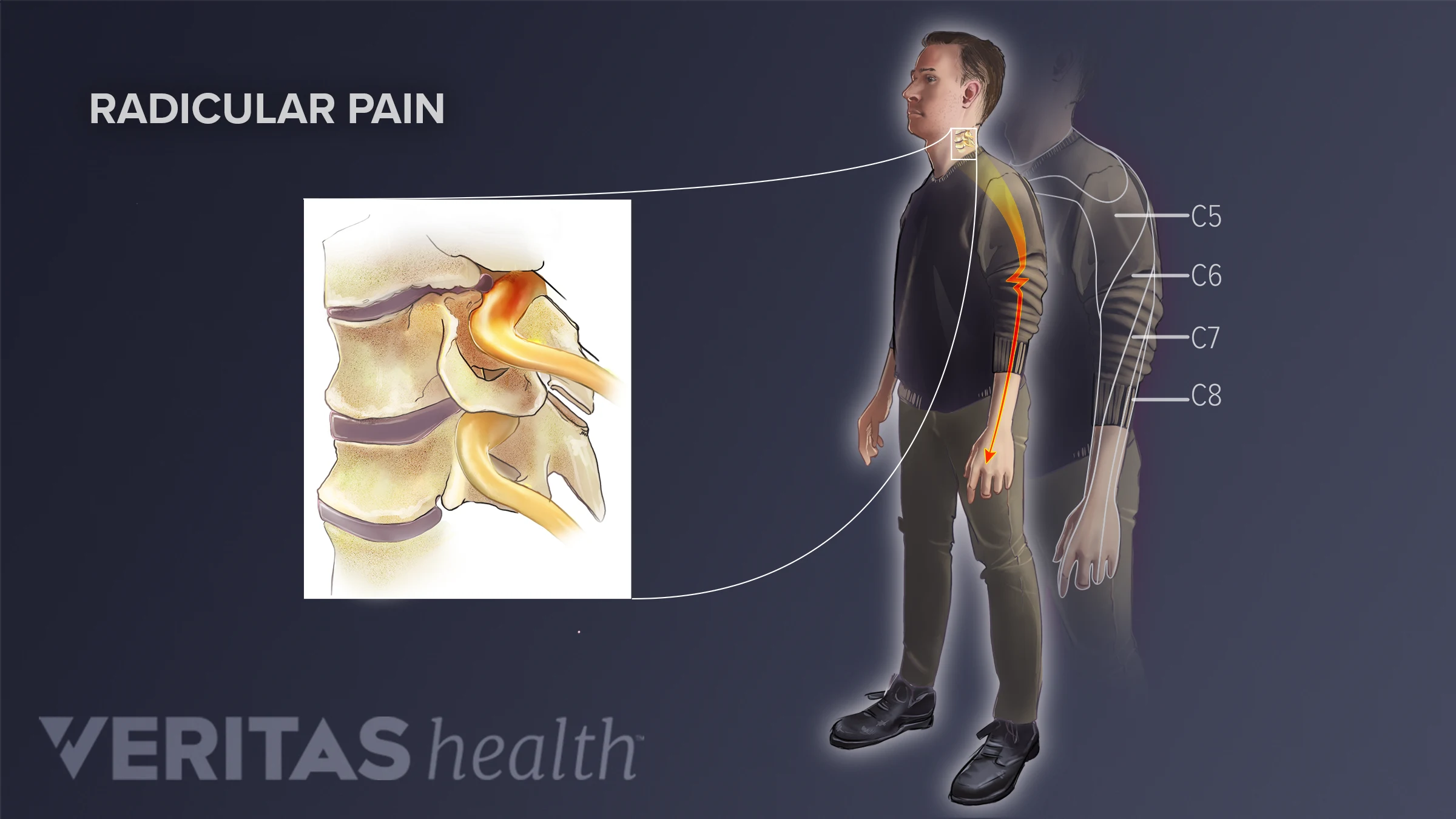 Radiculopathy, Radiculitis and Radicular Pain