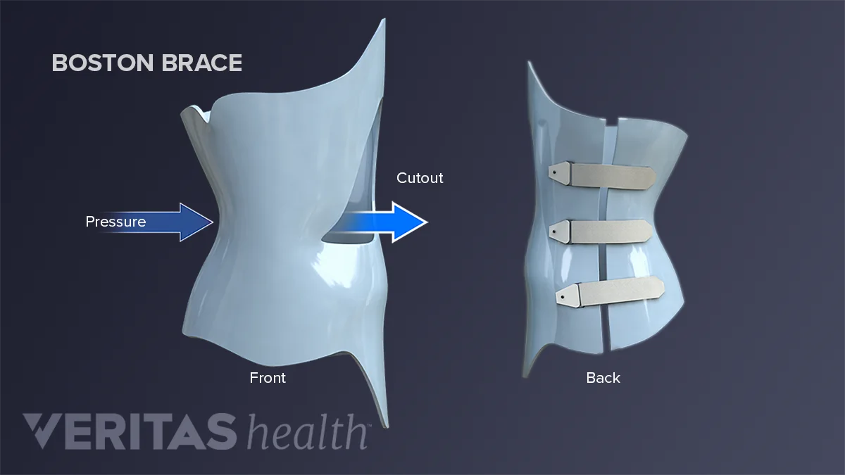 Types of Scoliosis Braces