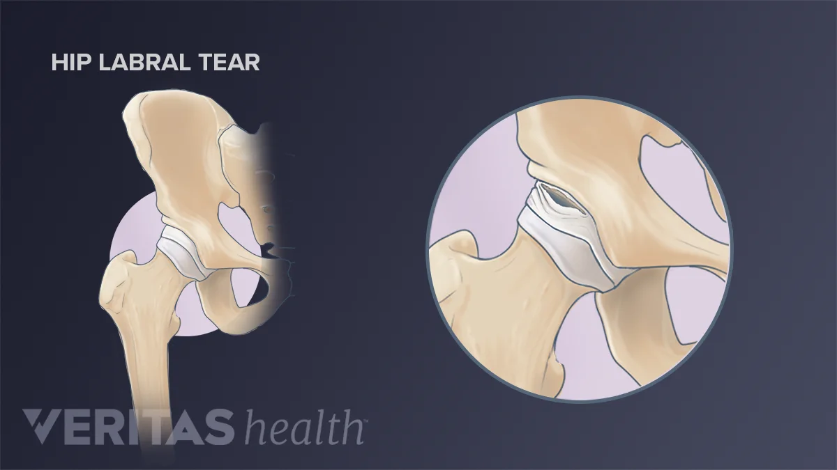 Coping with Hip Labral Tears Coping with Hip Labral Tears