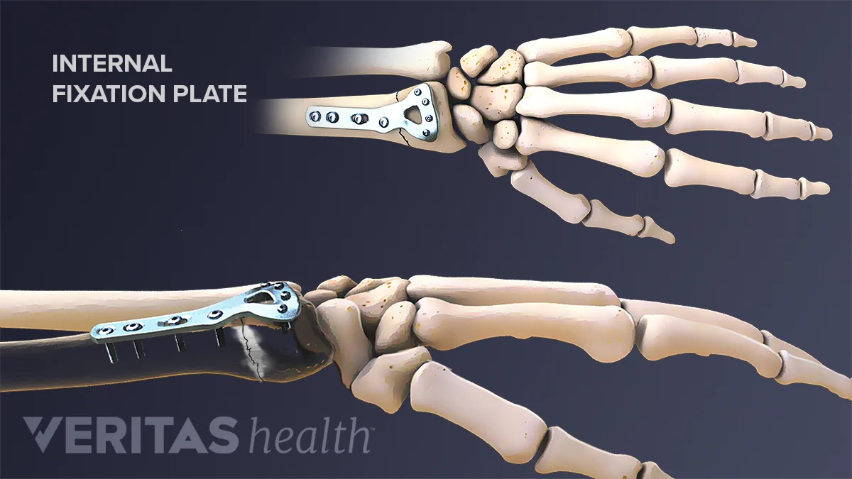 Surgical Options for Treating a Distal Radius Fracture