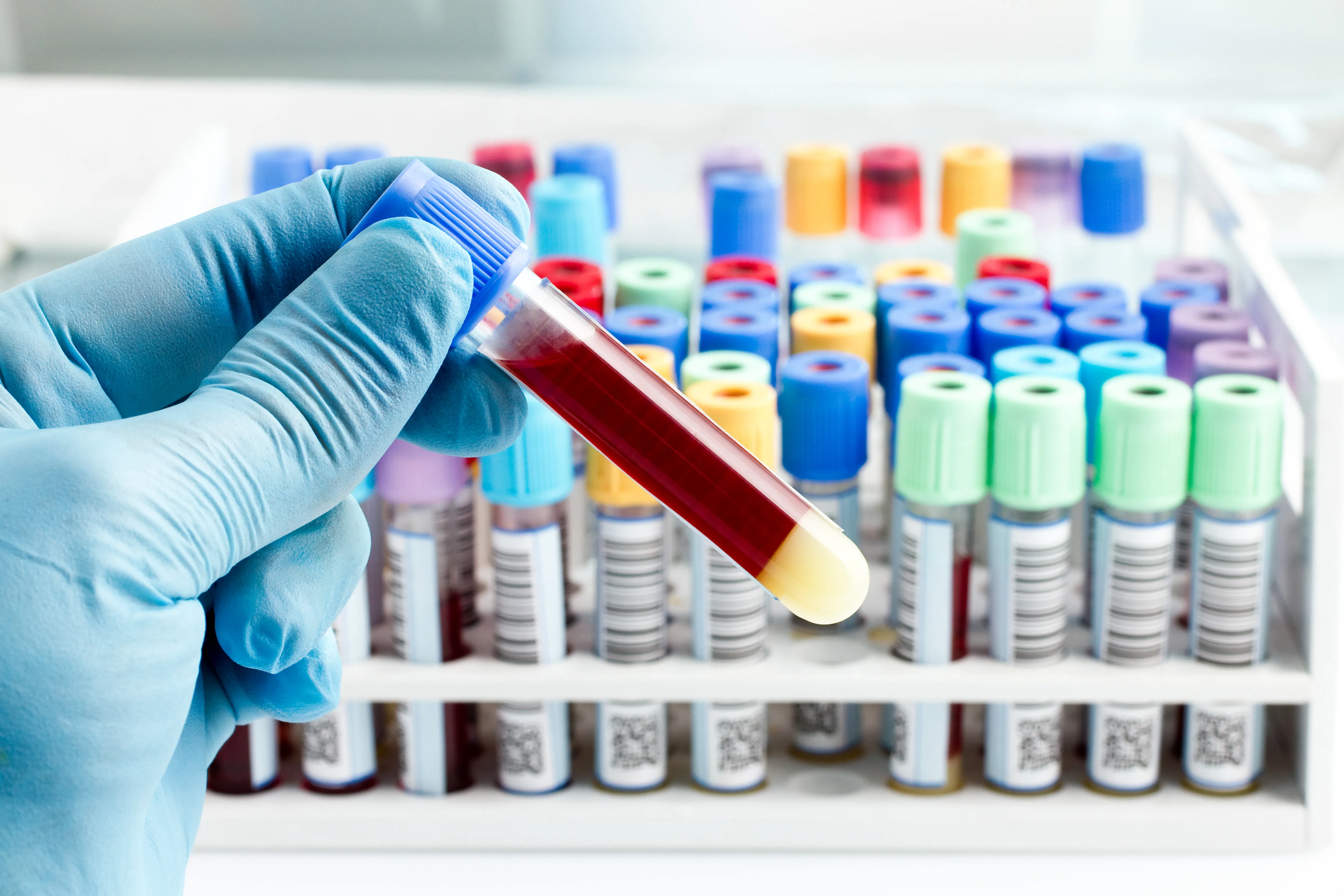 Check Ra Blood Tests to Help Diagnose Rheumatoid Arthritis (RA)