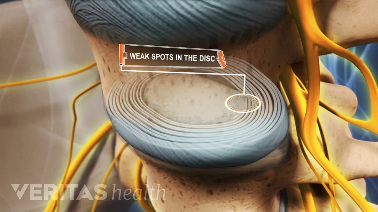 Disc At Risk Size Causes and Risk Factors of Lumbar Degenerative Disc Disease