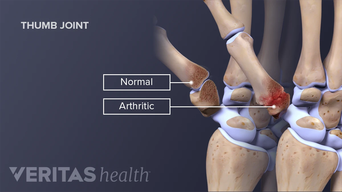 Does Cracking Your Knuckles Cause Arthritis? | Arthritis-health