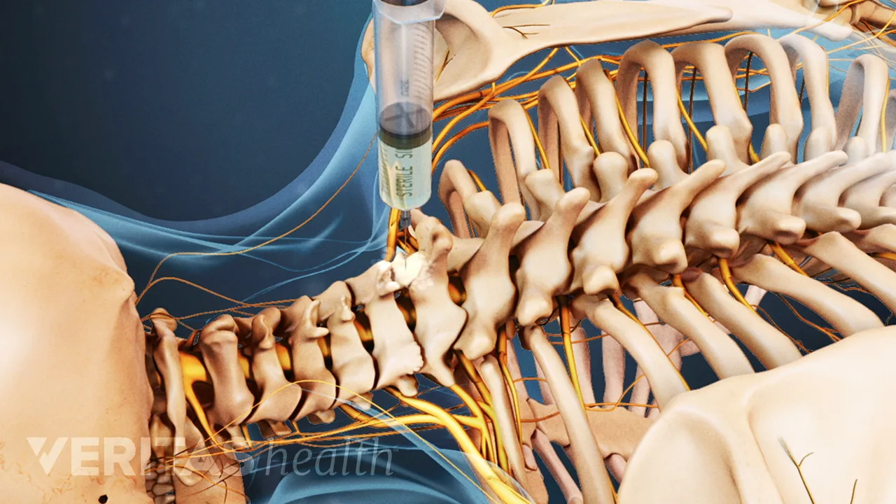Root Block Inj How Cervical Selective Nerve Root Blocks Can Ease Neck Pain | Spine-health