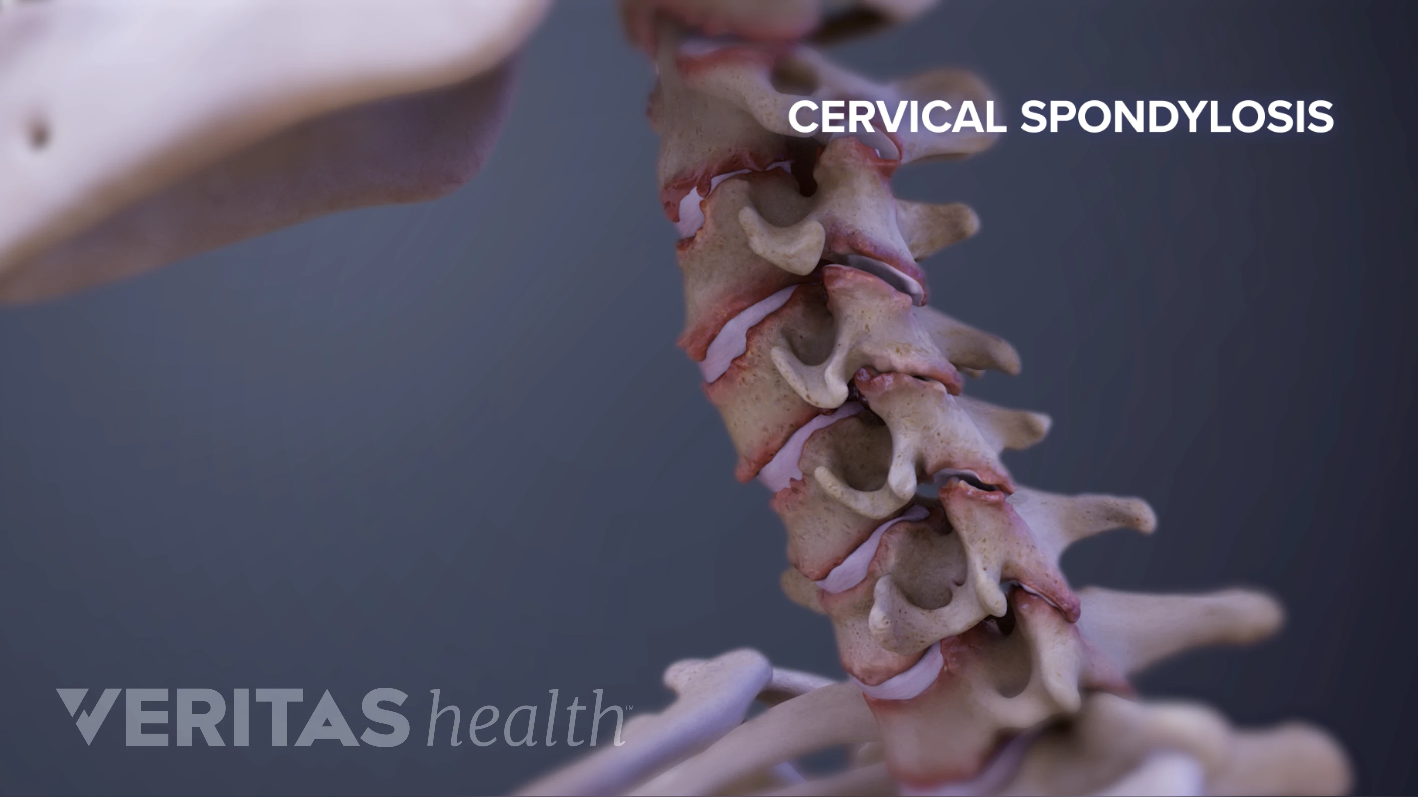 Spondylosis: What It Actually Means | Spine-health