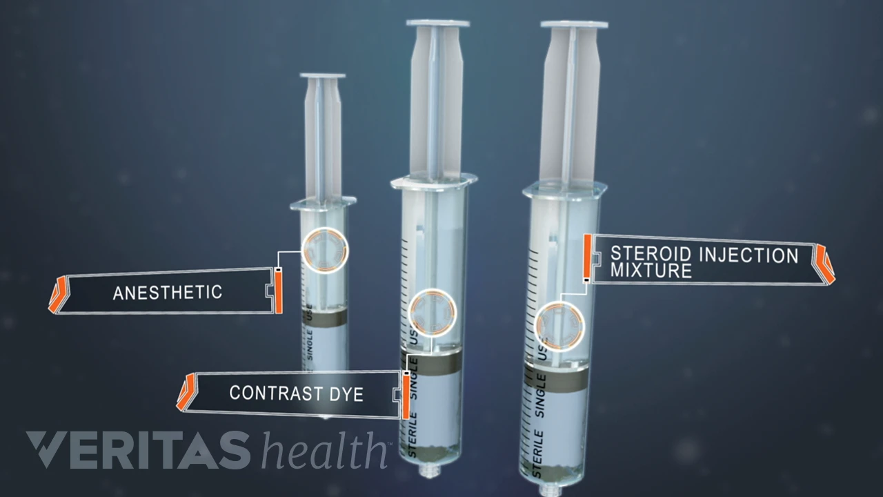 How Epidural Steroid Injections Work | Spine-health