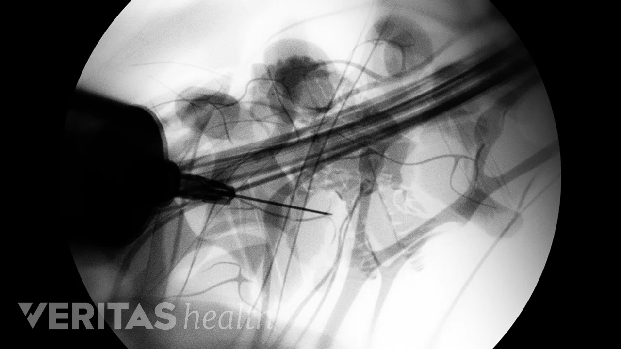 Medial Branch Block Video | Spine-health