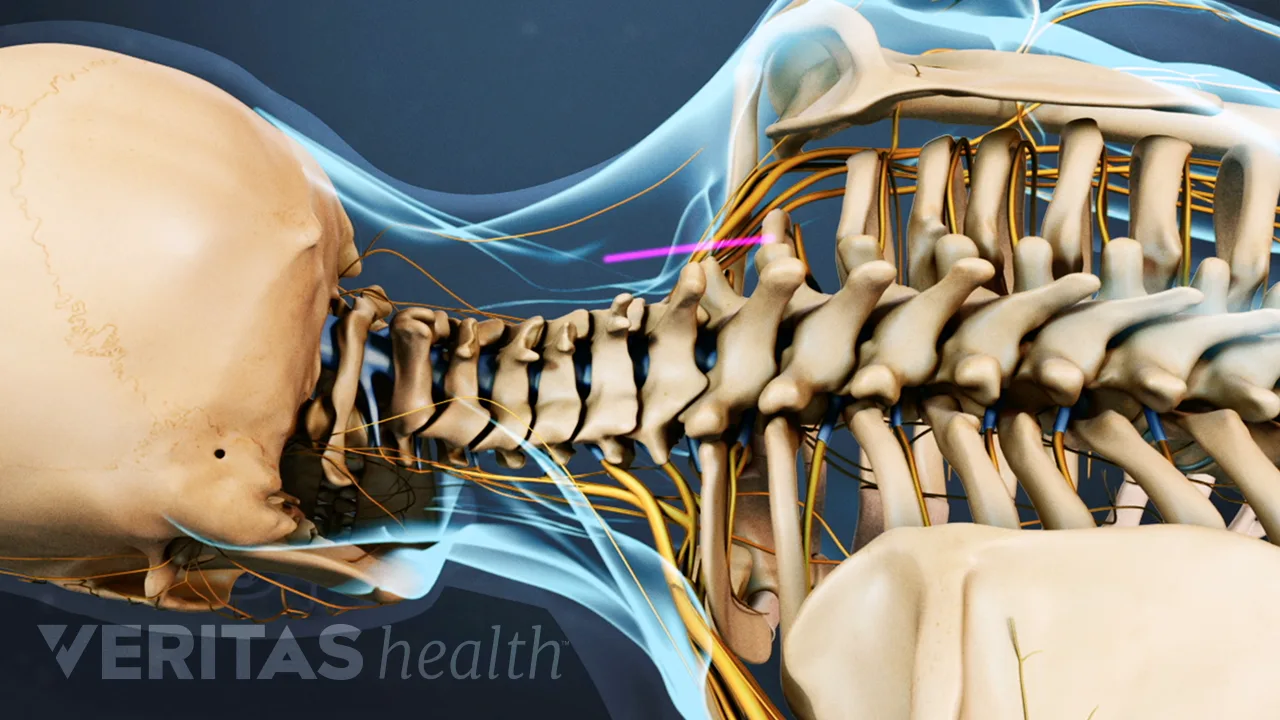 Anterior Cervical Corpectomy Spine Surgery | Spine-health