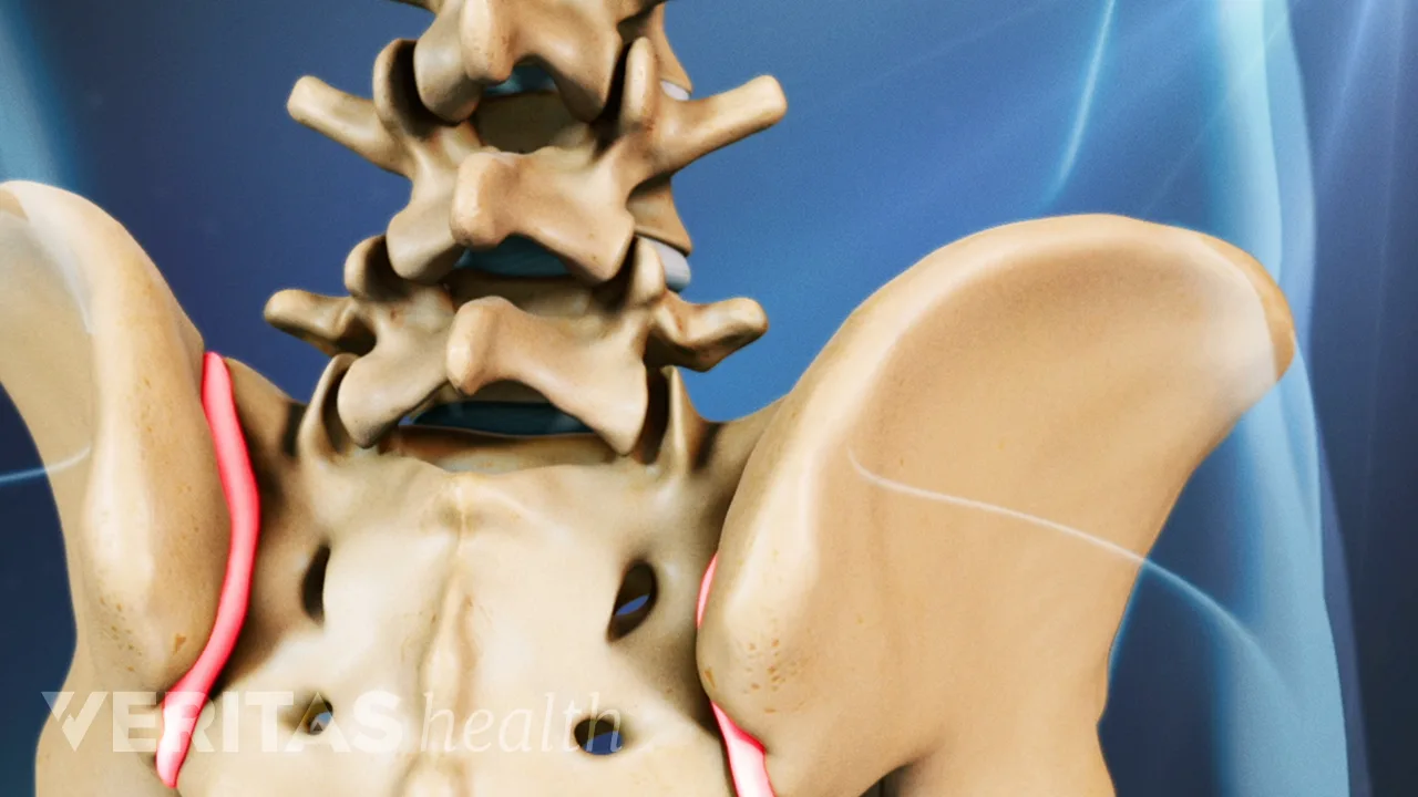 Common Triggers of SI Joint Pain and How to Prevent a Flare-up | Spine ...