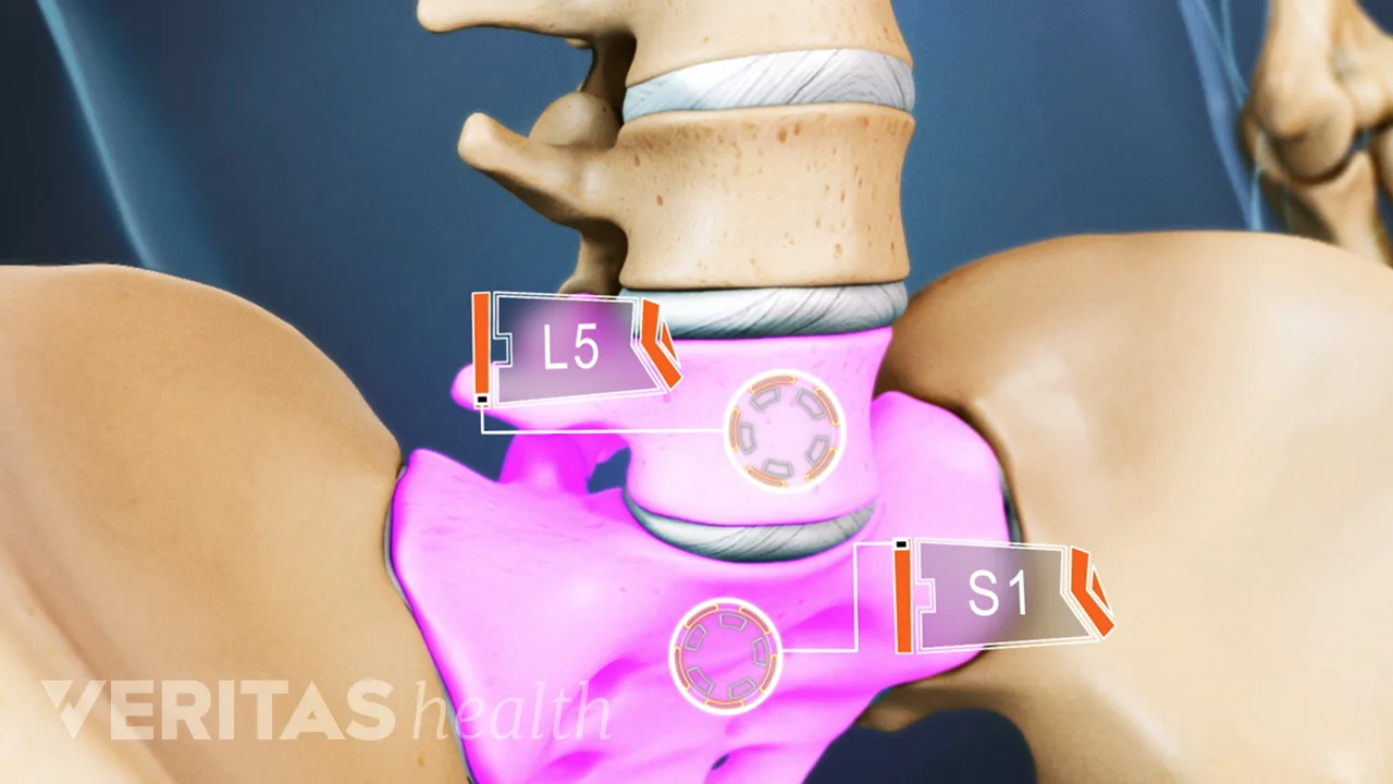 All about L5-S1 (Lumbosacral Joint) | Spine-health