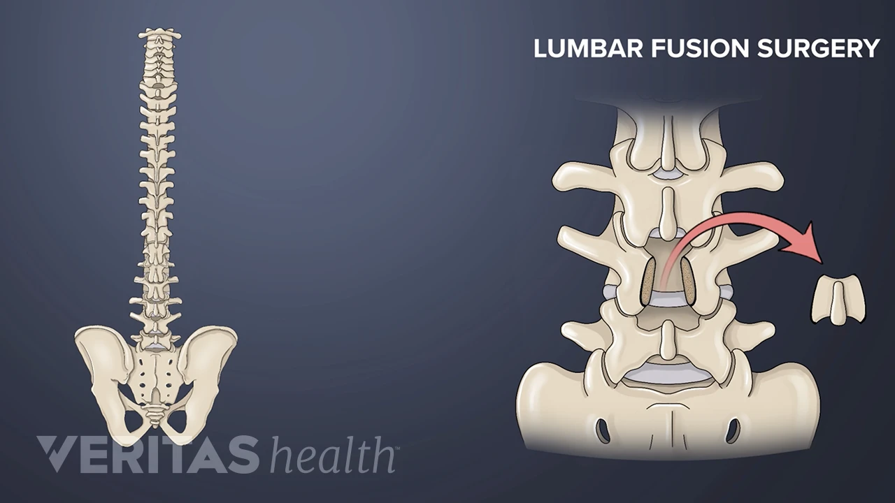 Bone Fusion Process Video: Stages of Bone Healing in Lumbar Spine Fusion Surgery | Spine-health