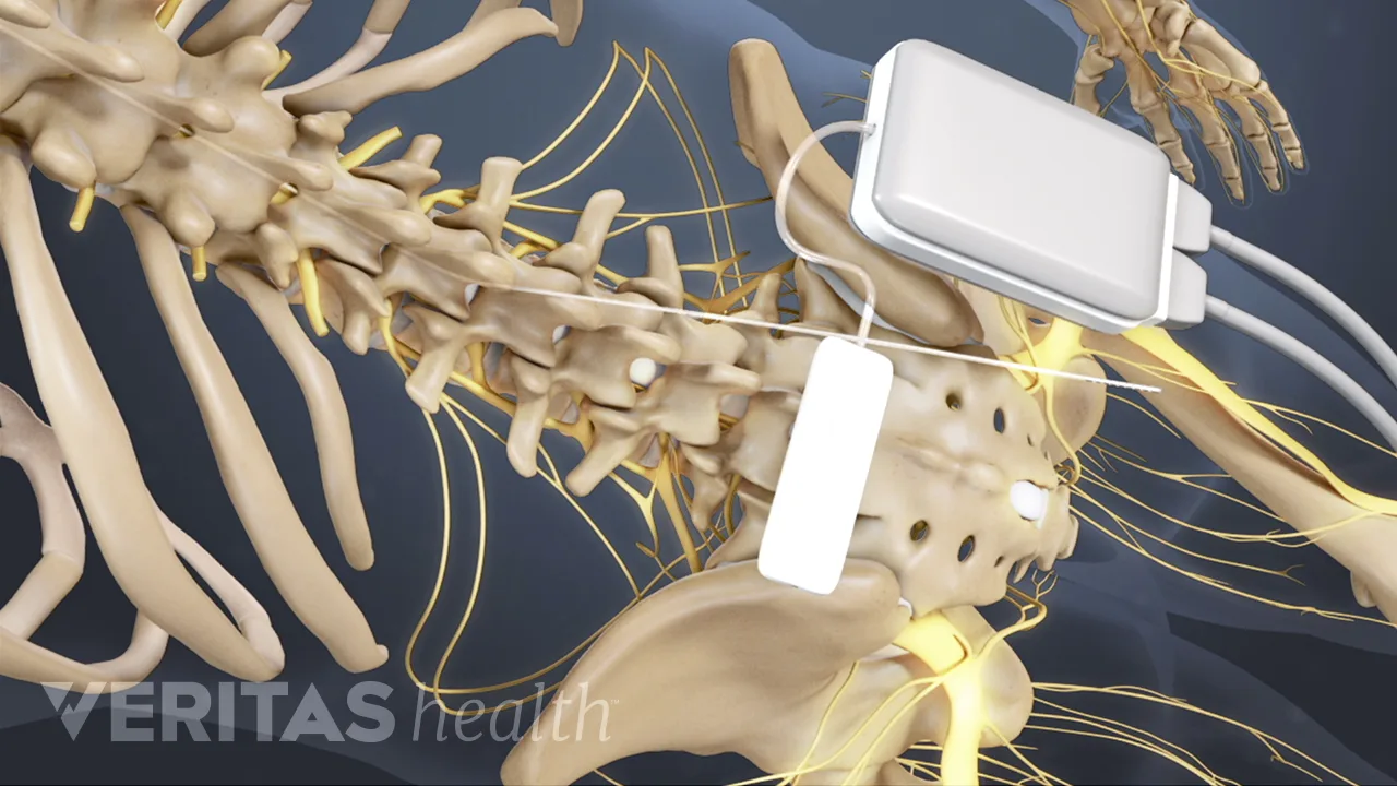 Spinal Simulator Controller Rechargeable Spinal Cord Stimulators for Chronic Pain | Spine-health