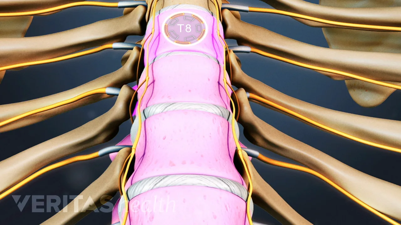Thoracic Herniated Disc Surgery | Spine-health