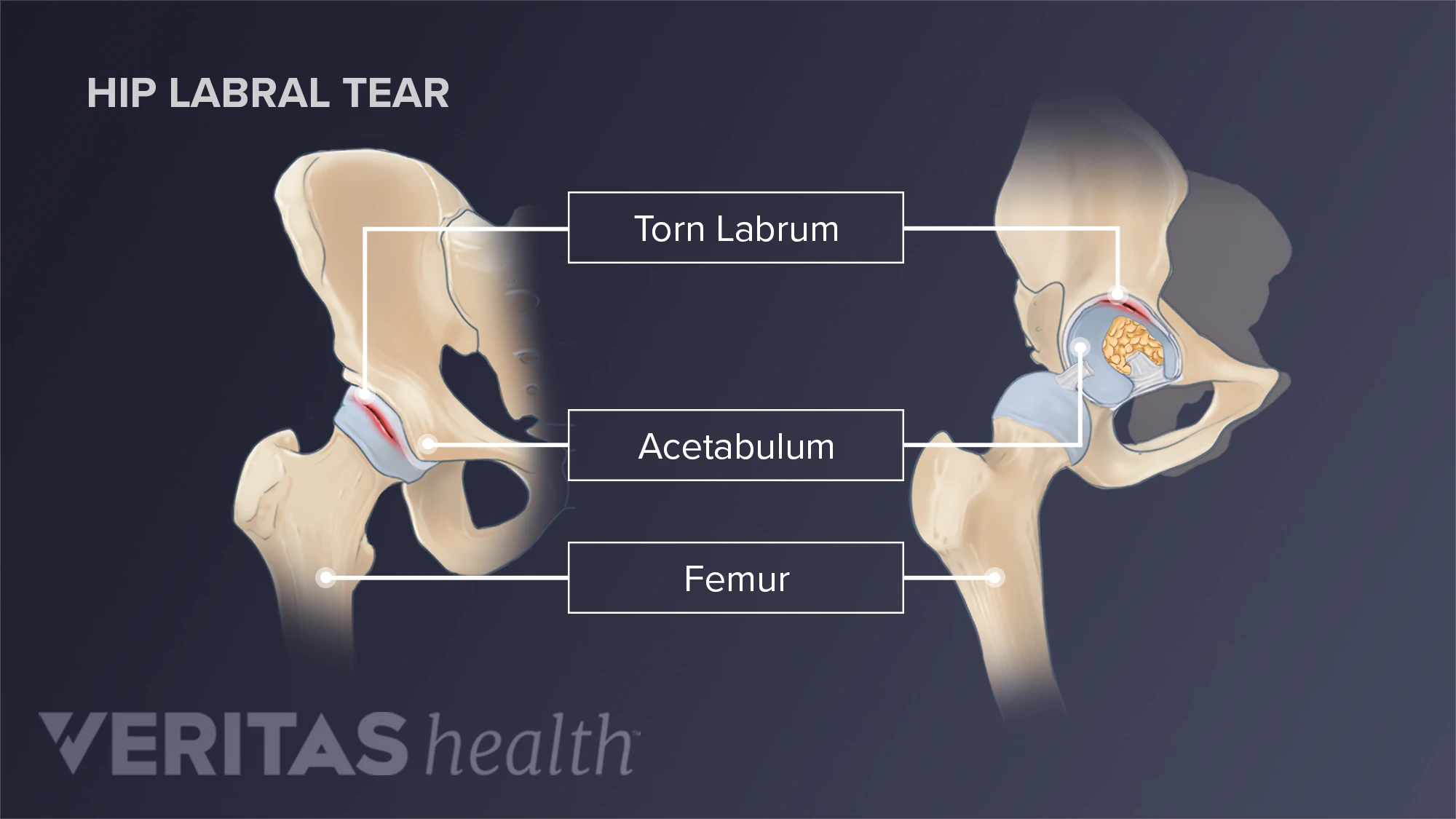 Can a Hip Labral Tear Cause Low Back Pain? | Sports-health