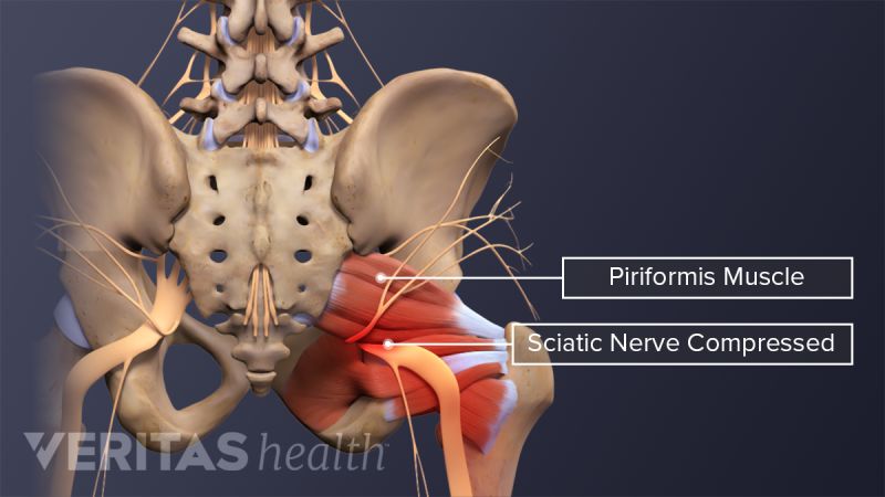 Piriformis Syndrome Video Spine health piriformis-syndrome-video-spine-health