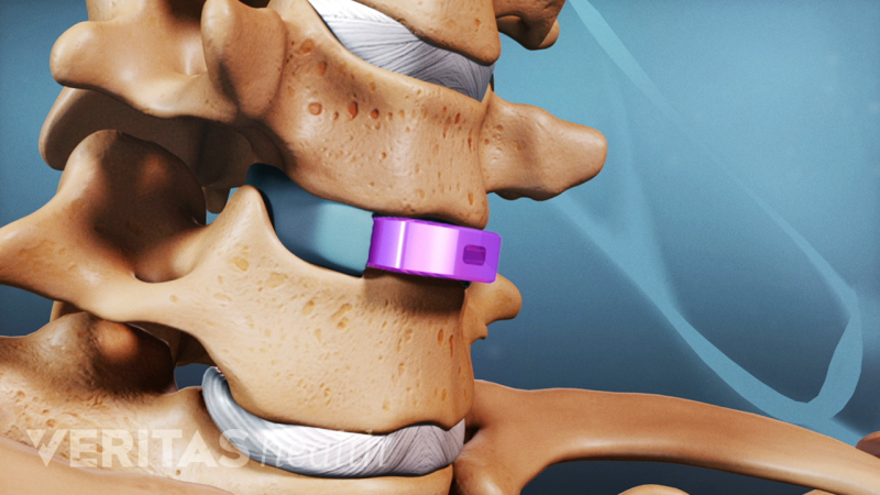 Cervical Degenerative Disc Disease Treatment Animation | Spine-health