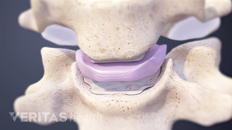 Neck Disc Numbers Cervical Disc Anatomy Animation | Spine-health
