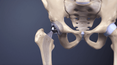 Anterior hip replacement