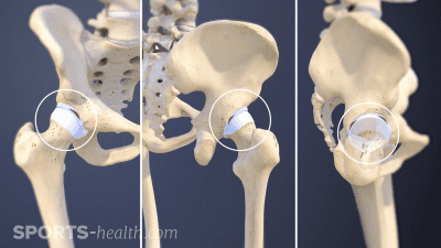 Anterior Posterior Combined Hip Labral Tears