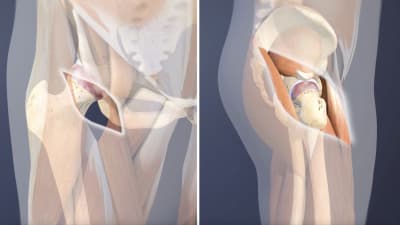 Minimally Invasive Hip Replacement vs. Traditional Hip Replacement