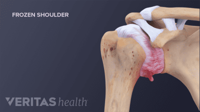 Anterior view of a frozen shoulder