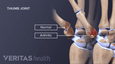 Medical illustration showing a healthy thumb joint and an arthritic thumb joint