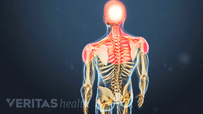 Posterior view of the upper body with pain in the head and shoulders.
