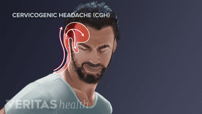 Man wincing in pain from cervicogenic headache