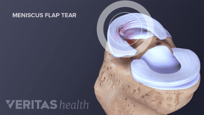 Flap tear in the knee meniscus