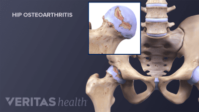 Medical illustration of osteoarthritis in the hip joint