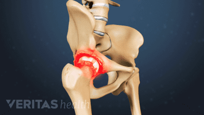 Medical illustration of hip inflammation