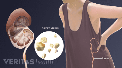 Illustration of kidney stones that are sometimes caused by gout