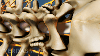 Multi-level Spinal Fusion Video