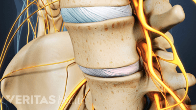Anterior view of the lumbar spine with a degenerated disc causing nerve pain.
