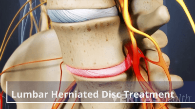 Anterior view of a lumbar herniated disc.
