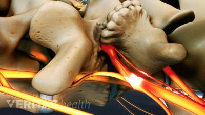 Nerve root compression