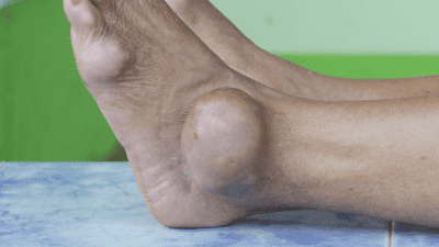 Gout attack in ankle