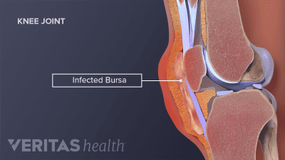 Medical illustration showing an infected bursa on the knee