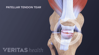 Anterior view of a ruptured patellar tendon